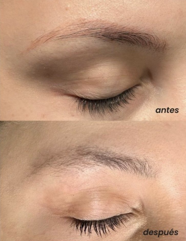 Antes y después: remoción de micropigmentación de cejas en 2 sesiones
