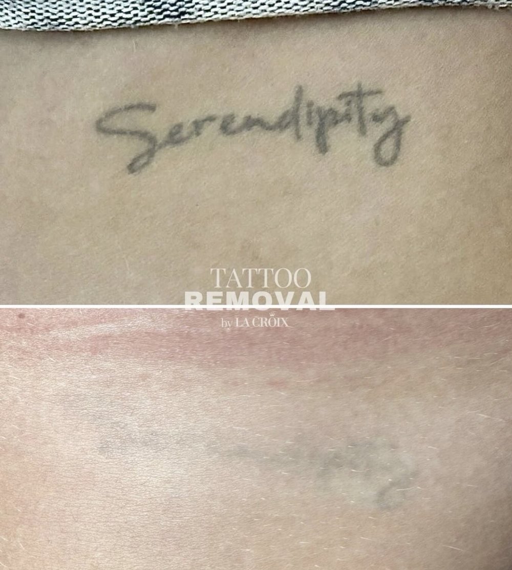 Antes y después: tatuaje de texto aclarado con láser