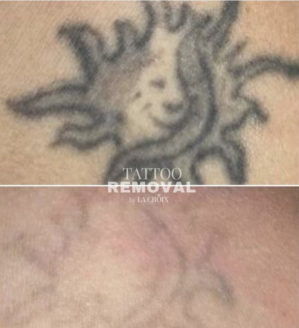 Antes y después: tatuaje de sol aclarado con láser