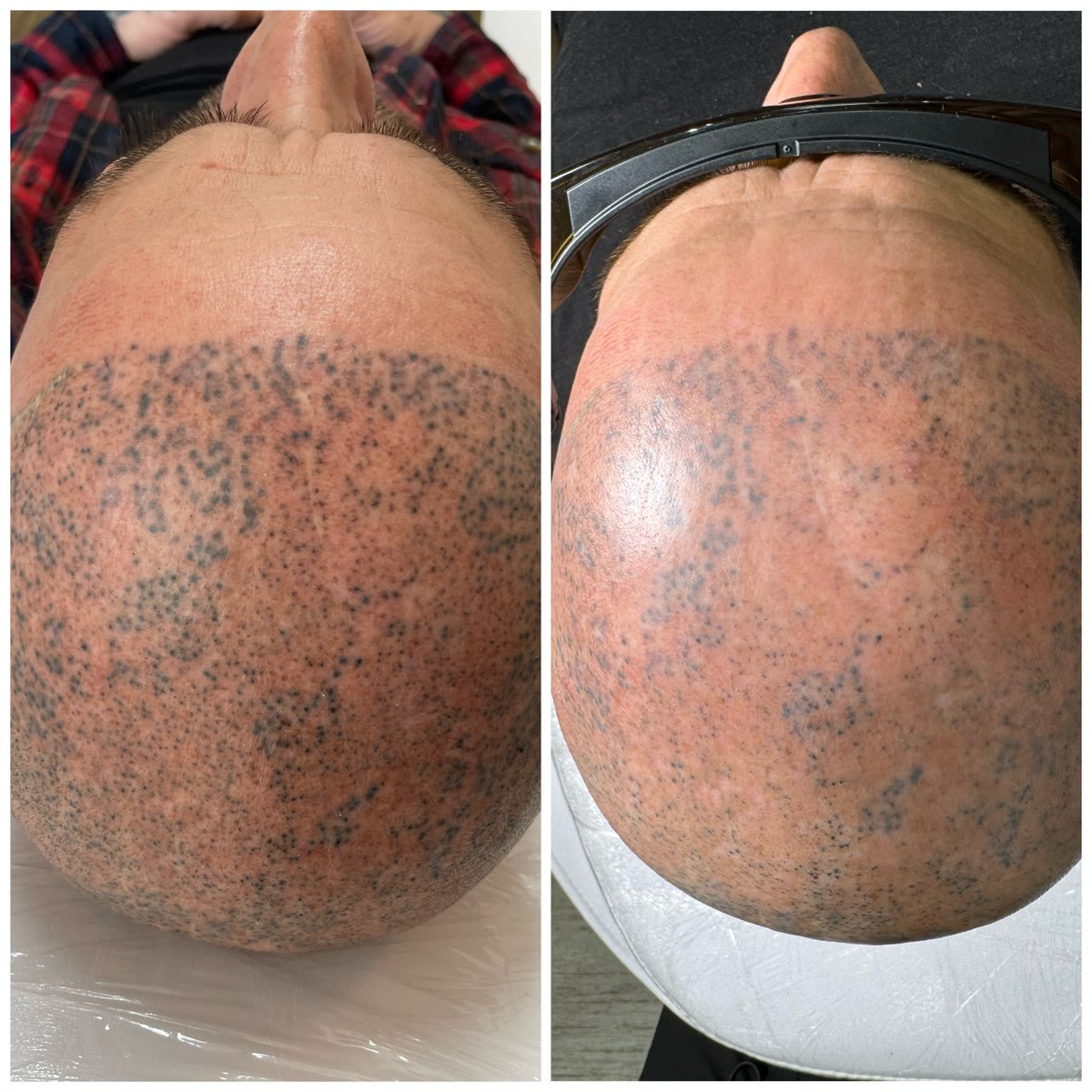 Remoción de micropigmentación capilar con láser: antes y después de una sola sesión