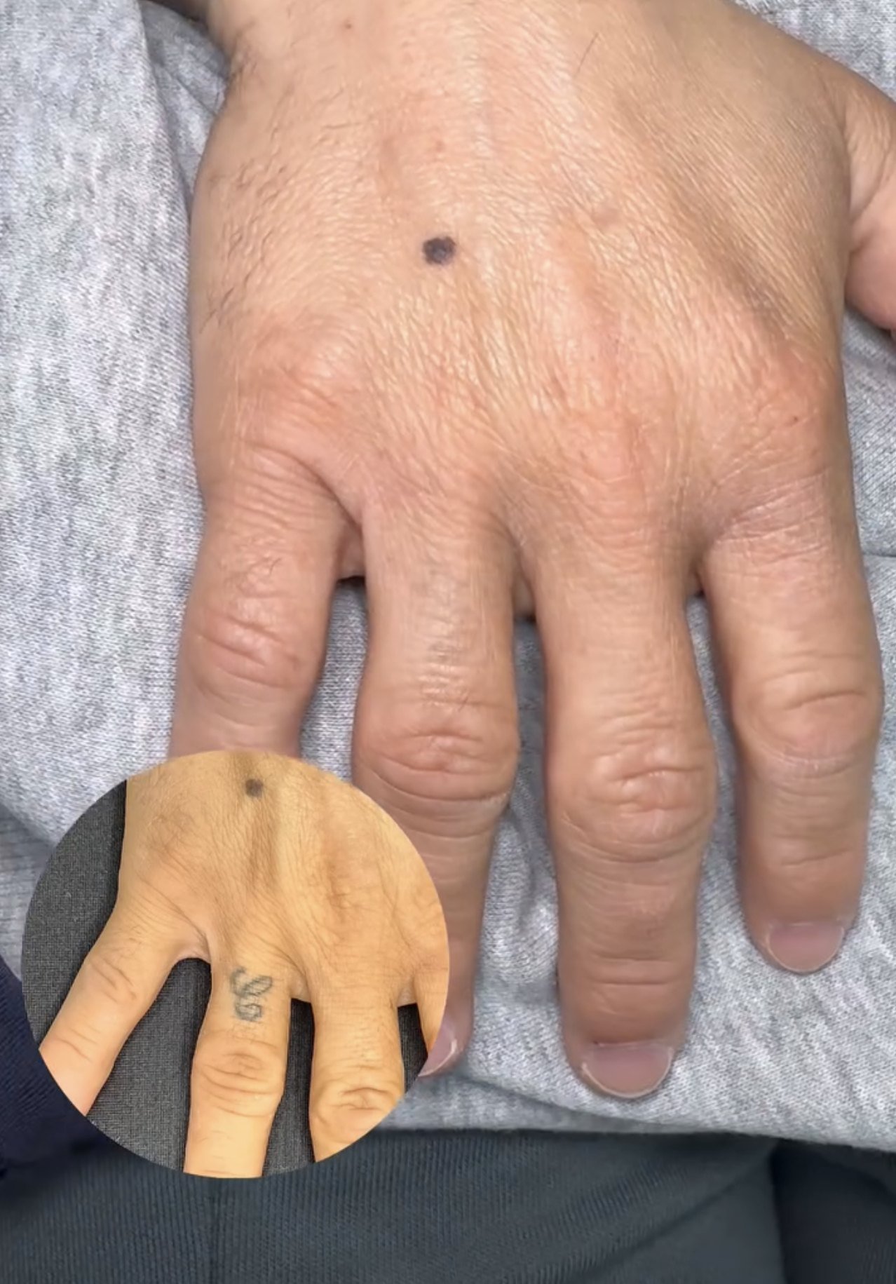 Tatuaje en el dedo eliminado tras la última sesión de láser