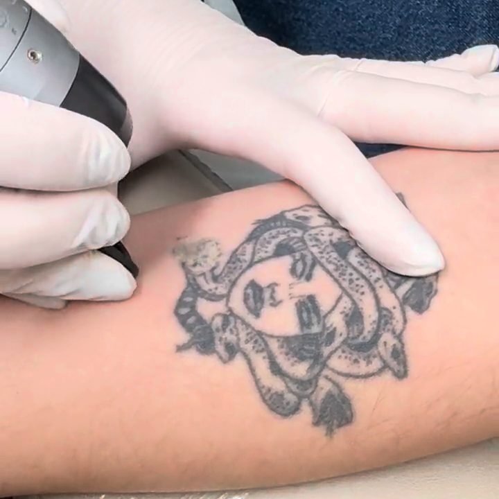 Remoción de tatuaje con láser ALMA Q en Tattoo Removal Uruguay