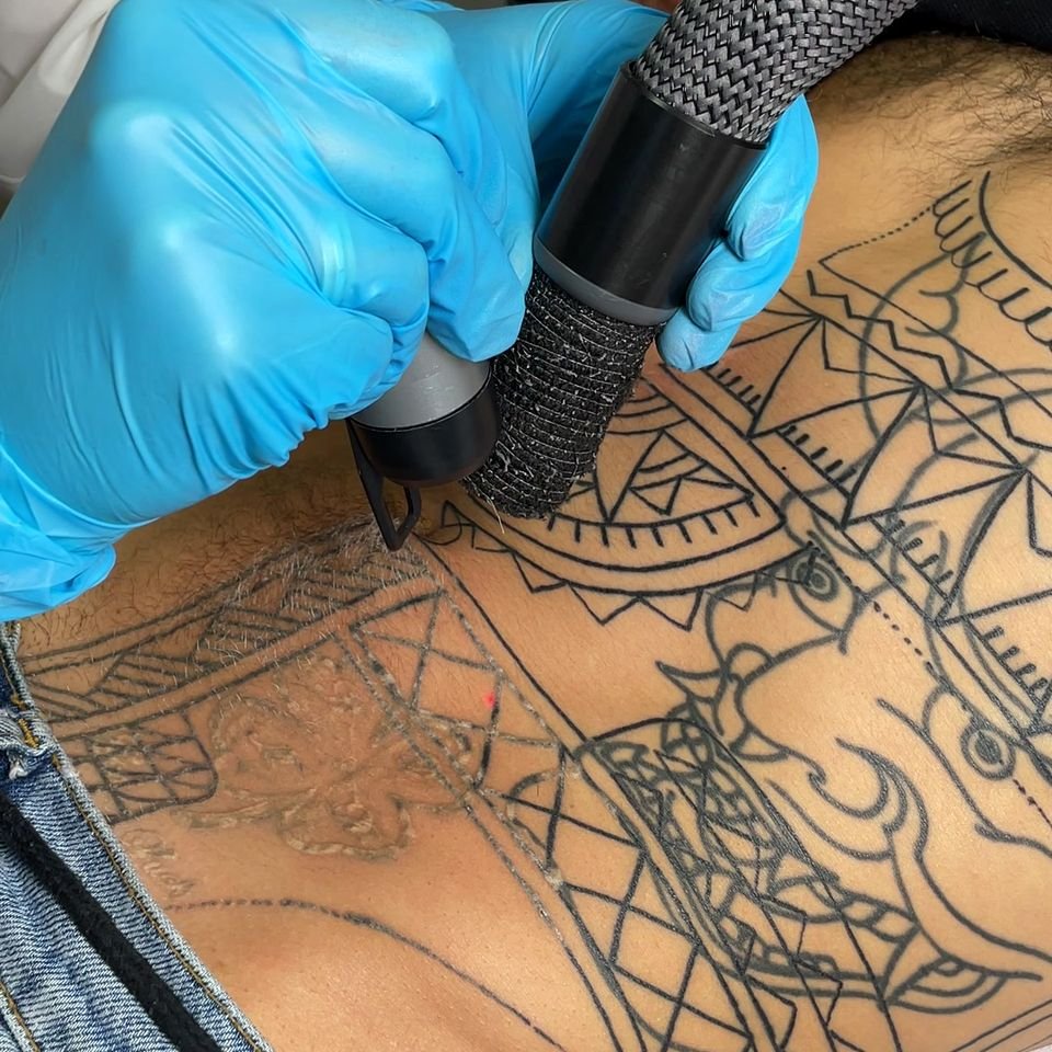 Remoción de tatuajes con láser Alma Q en Carrasco